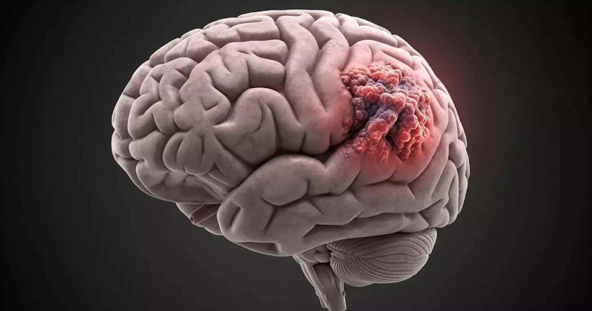 Brain Tumour: Risk Factors, Complications & Symptoms