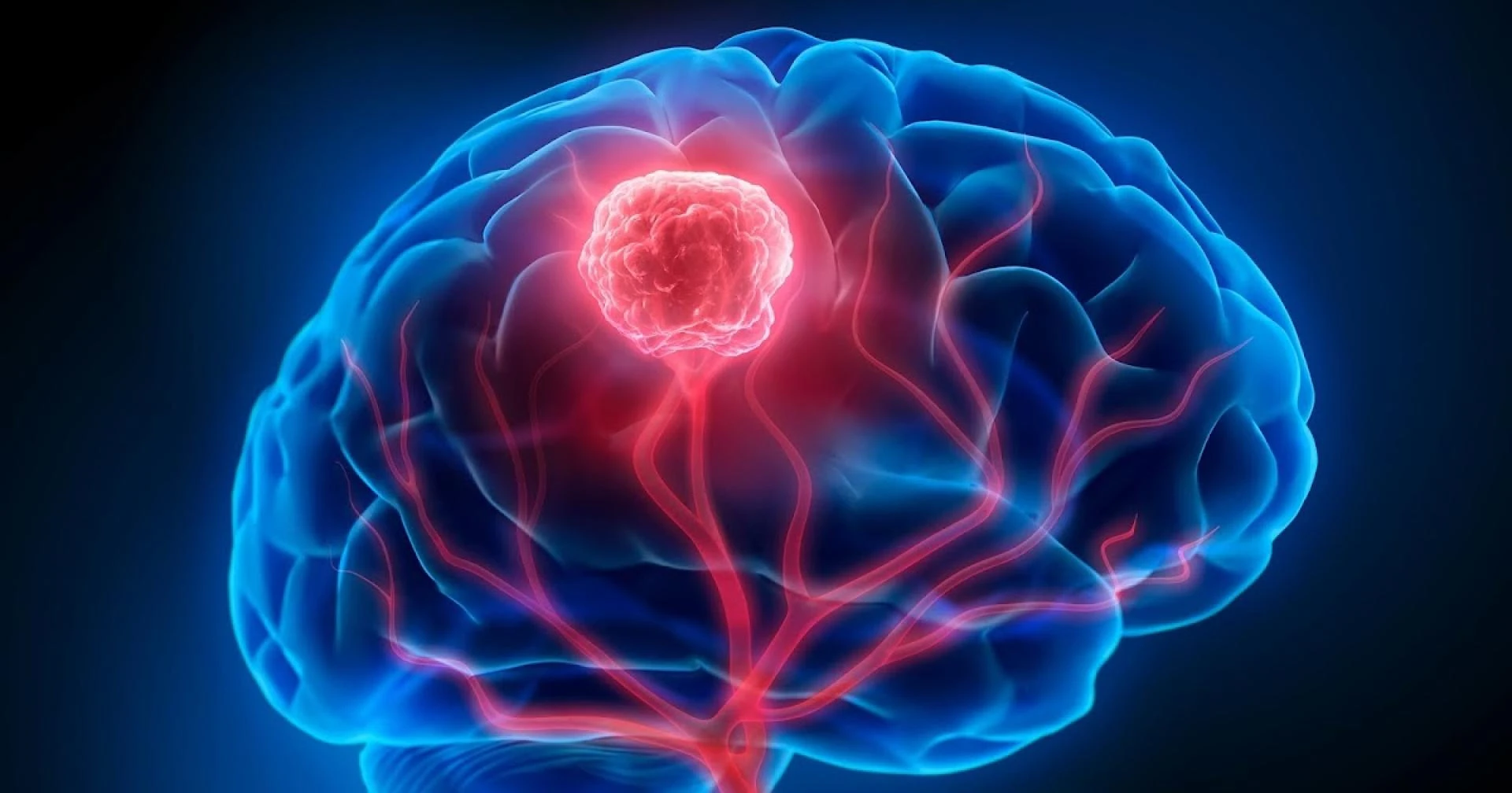 5 Early Brain Tumour Symptoms That Are Often Dismissed