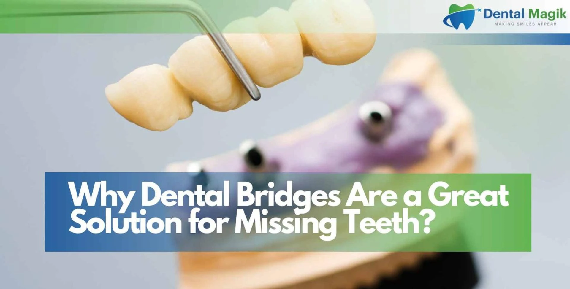 Why Dental Bridges Are a Great Solution for Missing Teeth?