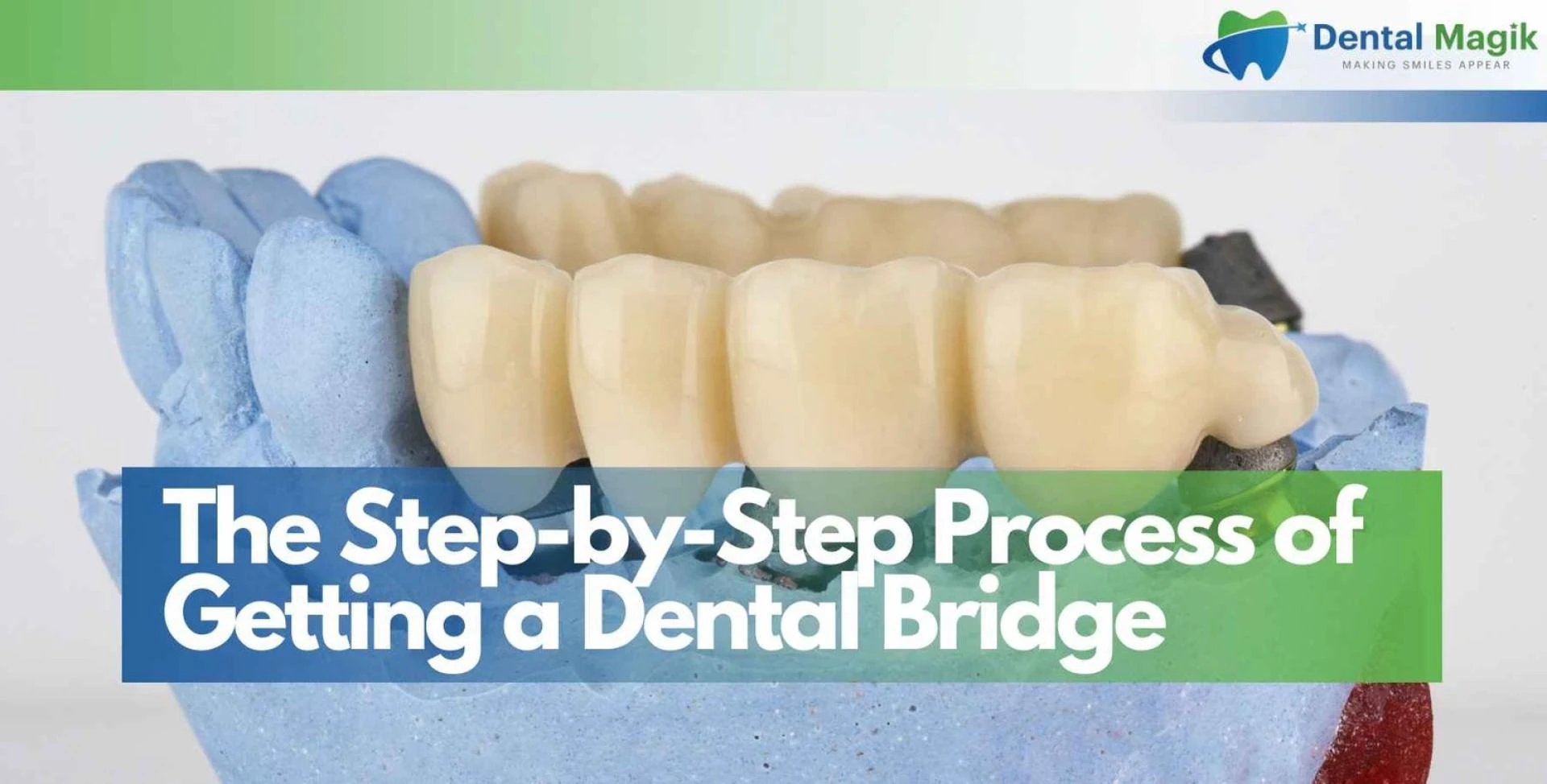 The Step-by-Step Process of Getting a Dental Bridge