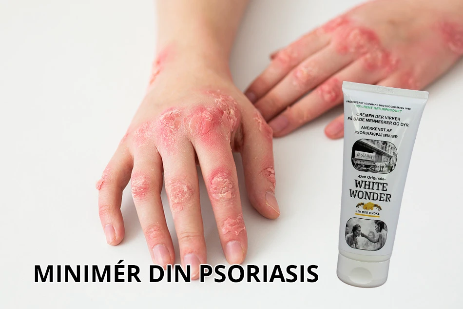 Psoriasis