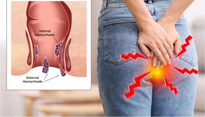 Ayurvedic Approaches for Effective Piles Treatment