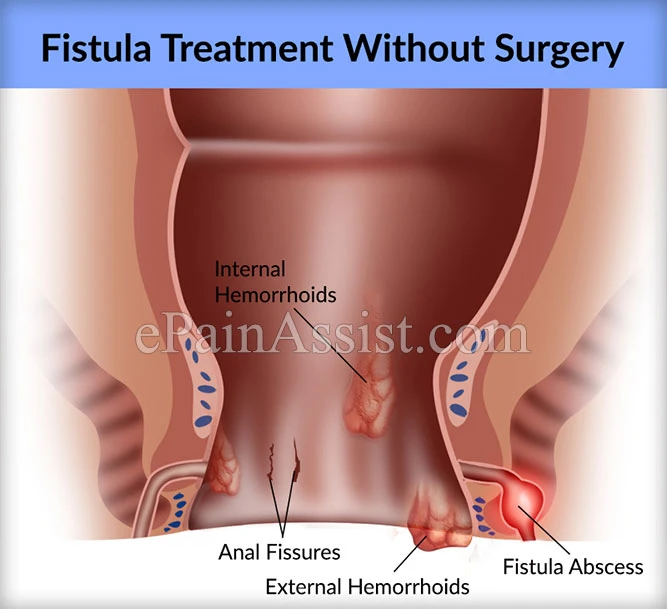 Ayurvedic Fistula Treatment in Ghaziabad for Quick Relief