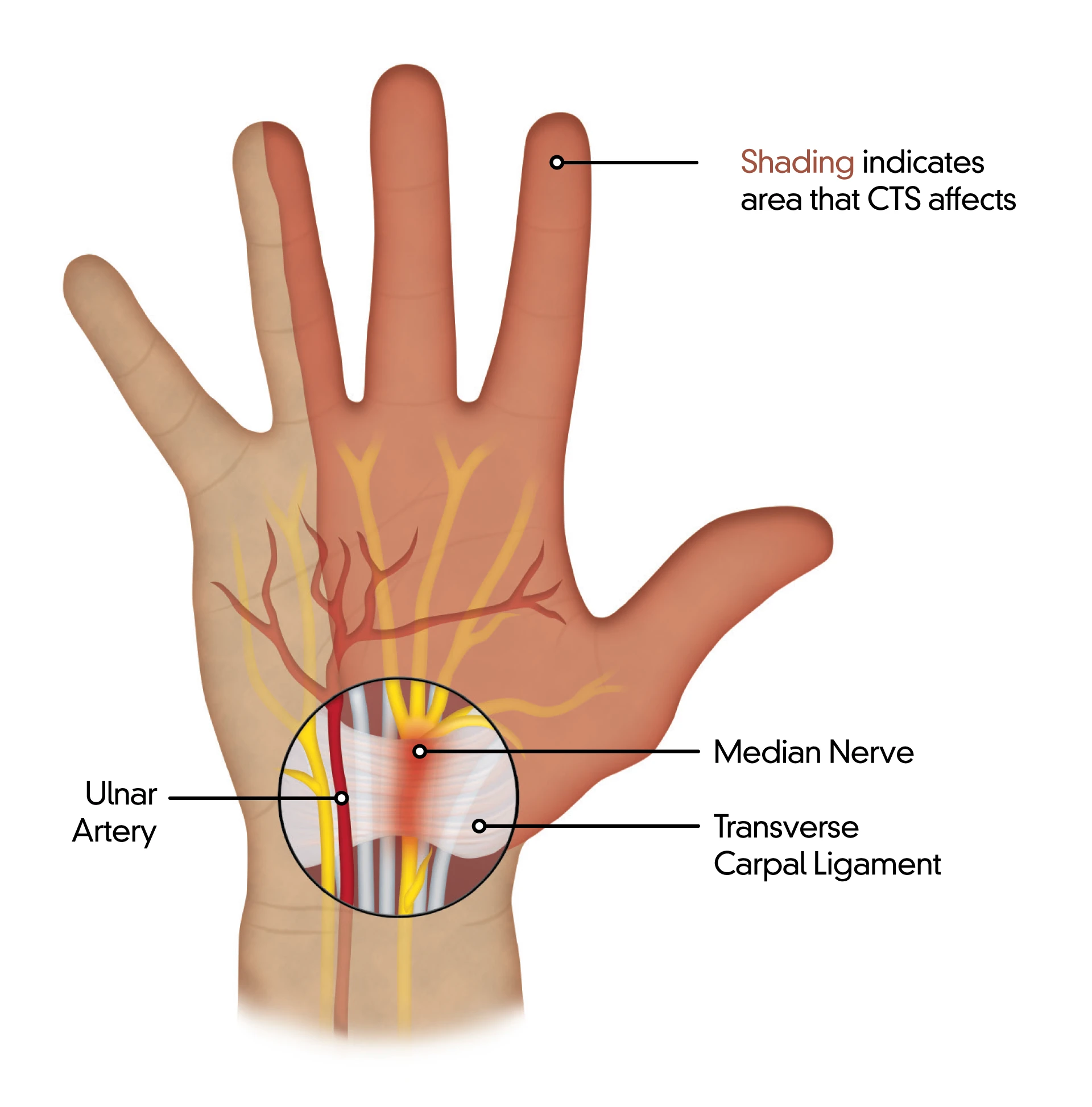 Things to know about Finger Fractures and quick recovery