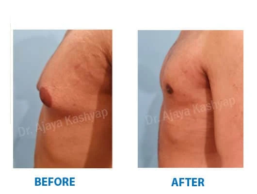 Gynecomastia - Men with Enlargement of Breasts