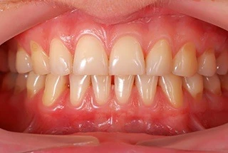 Periodontal Disease Therapeutics Market Share, Growth, Global Analysis, Trends, Market Size, and Forecasts 2018 - 2026