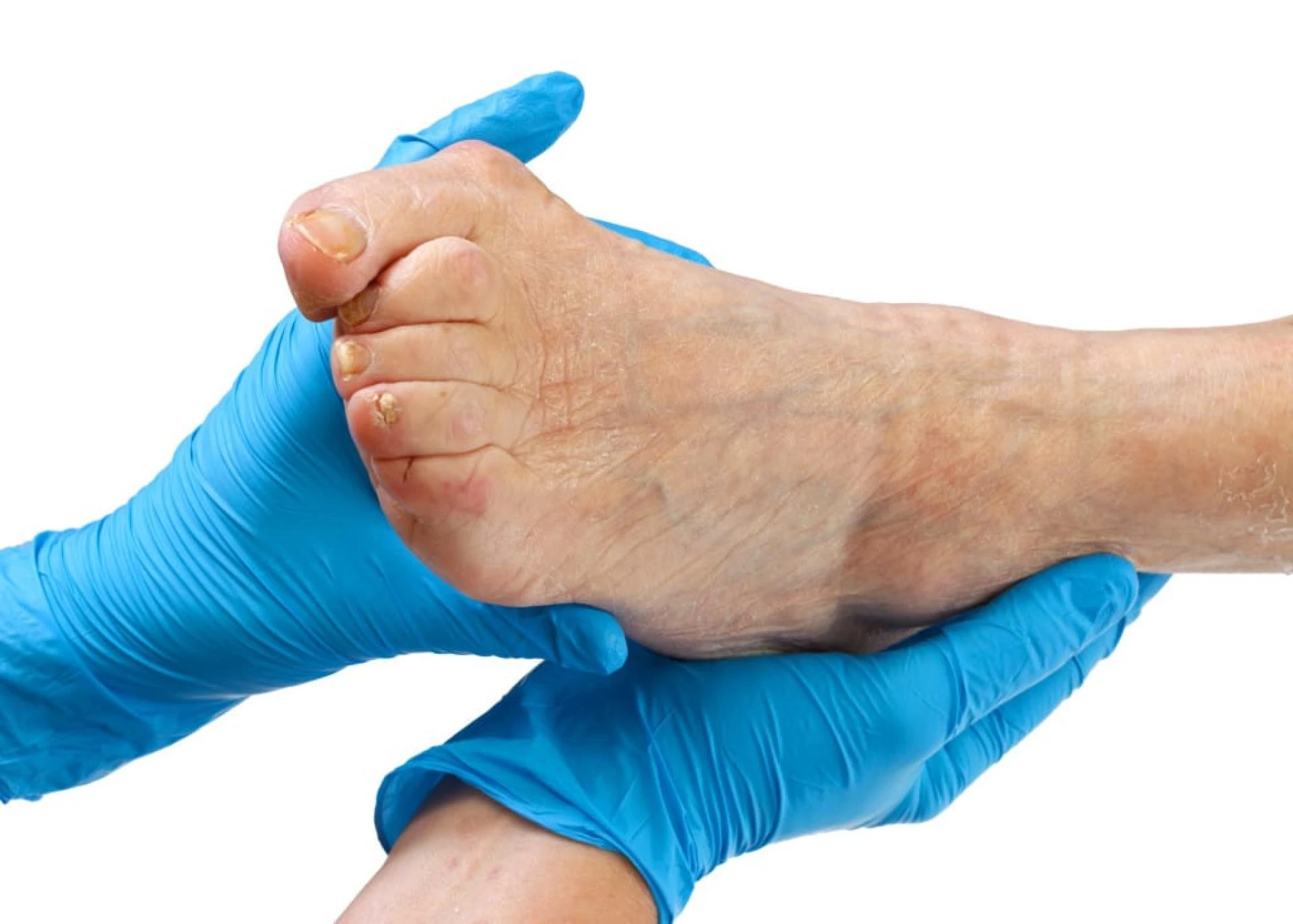 Bunion Deformity: Causes and Treatment