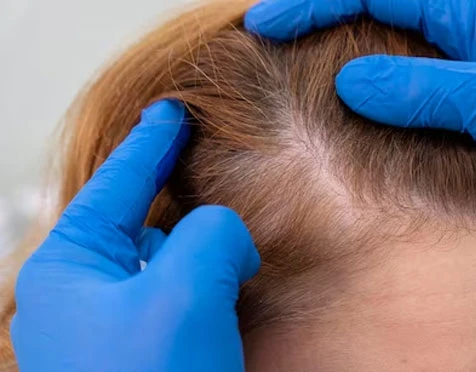 Avoiding Costly Mistakes: Common Hair Line Treatment Missteps To Avoid