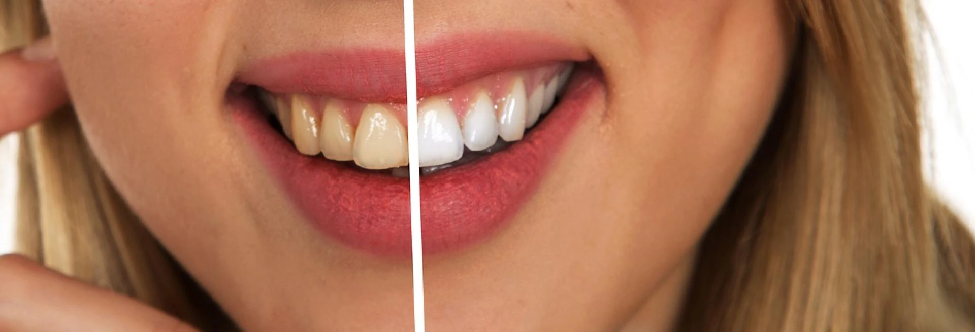 Unveiling the Secrets of Teeth Whitening in Streatham