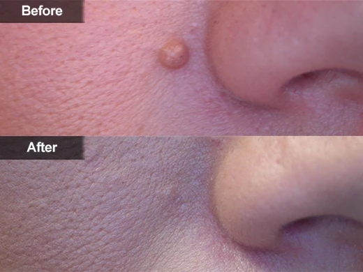 Birthmark Removal Cost A Comprehensive Guide