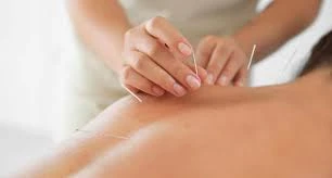 Acupuncture Dublin Clinic - Your Path to Holistic Healing and Pain Relief