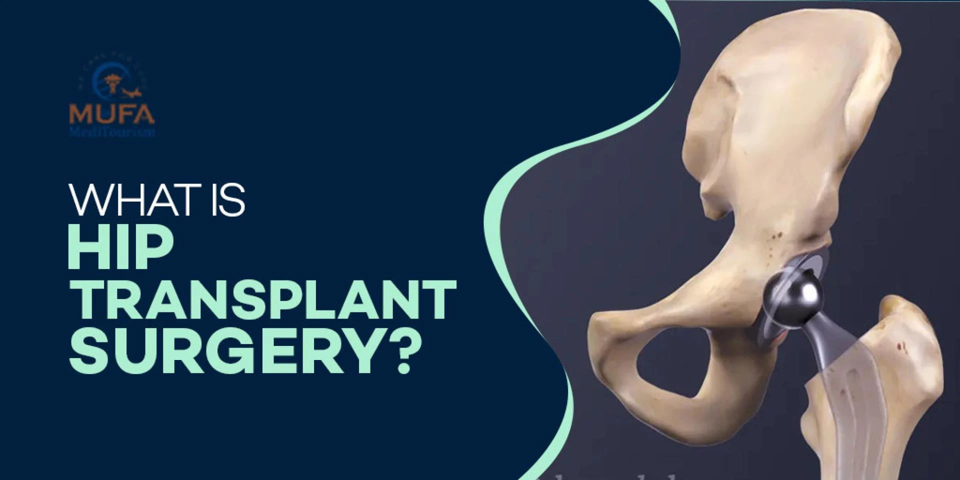 What is hip transplant surgery?