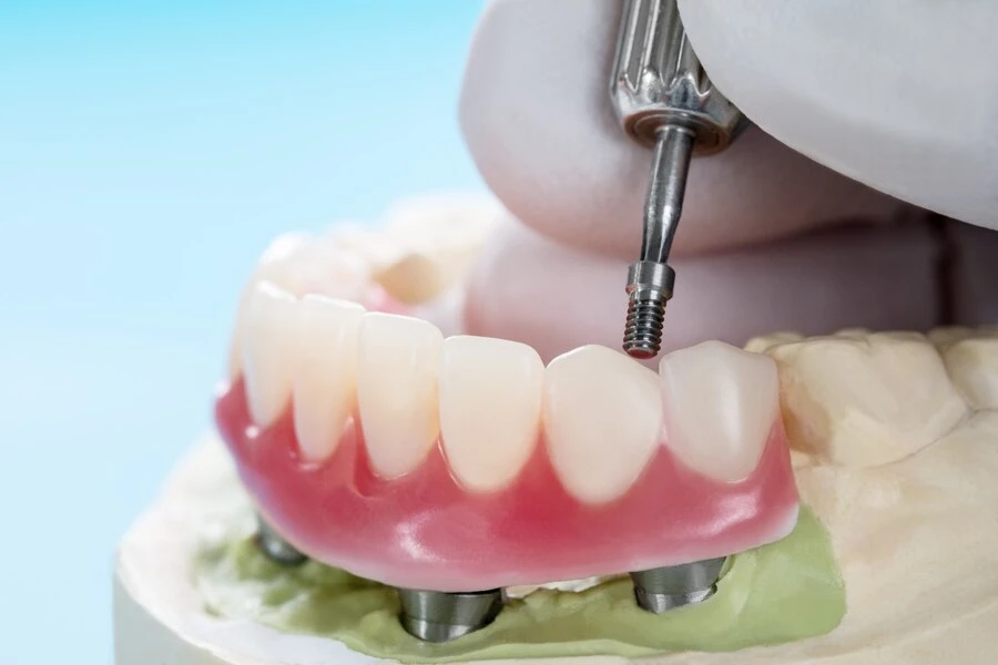 Procedure for Overdentures: A Step-by-Step Guide