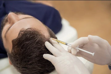 Procedure for PRP Hair Loss Treatment
