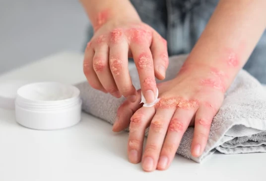 Understanding Psoriasis: Types, Symptoms, and Triggers