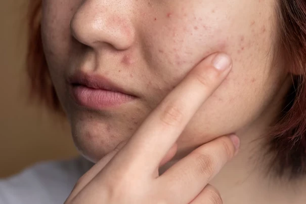What are some common misconceptions about acne scars and their treatment?