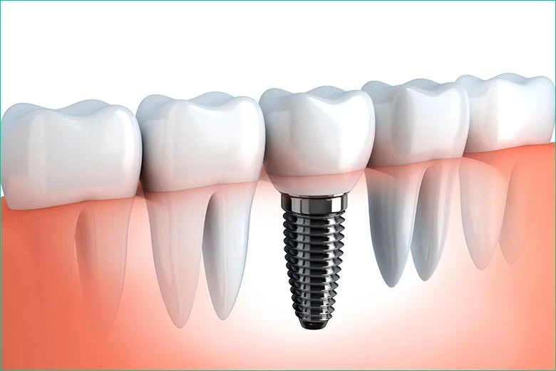 Dental Implants Are the Best Option for a Tooth Replacement