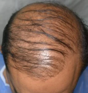 Advantages and disadvantages of hair transplant surgery