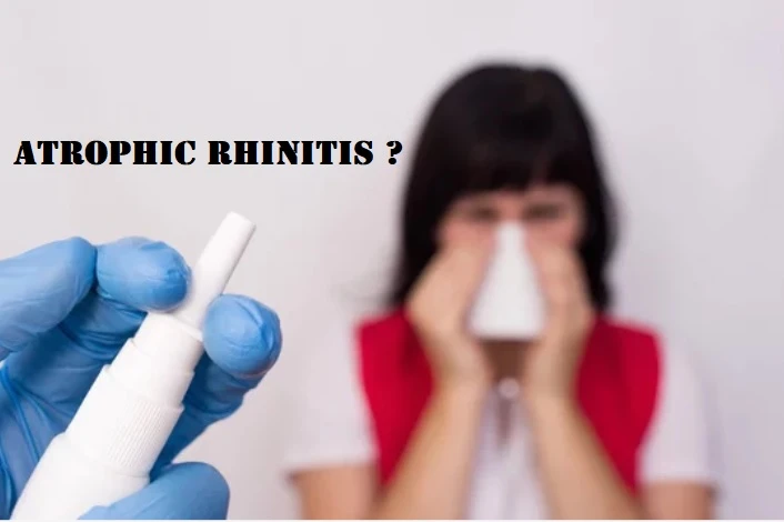 What Is Atrophic Rhinitis: A Guide To Follow