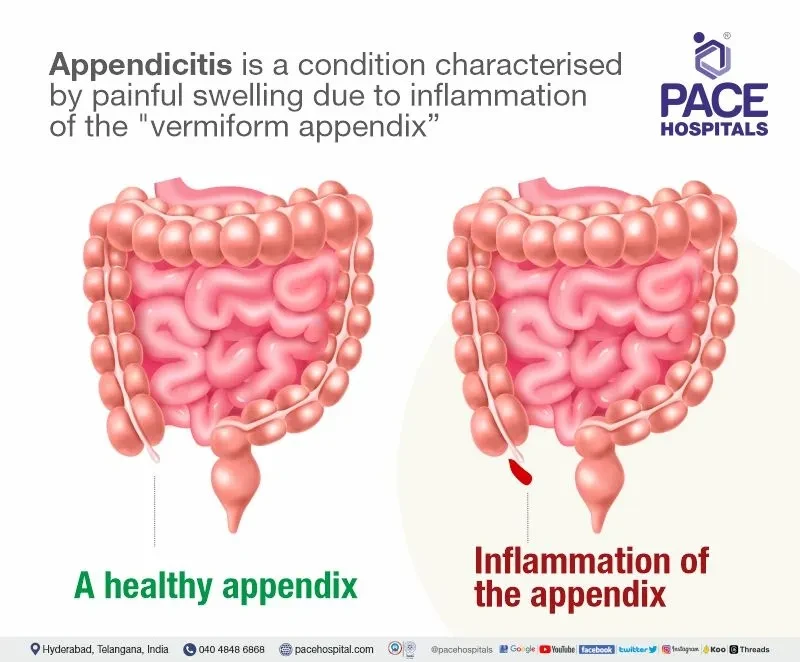 Understanding Appendicitis: Symptoms, Diagnosis, and Treatment at PACE Hospitals