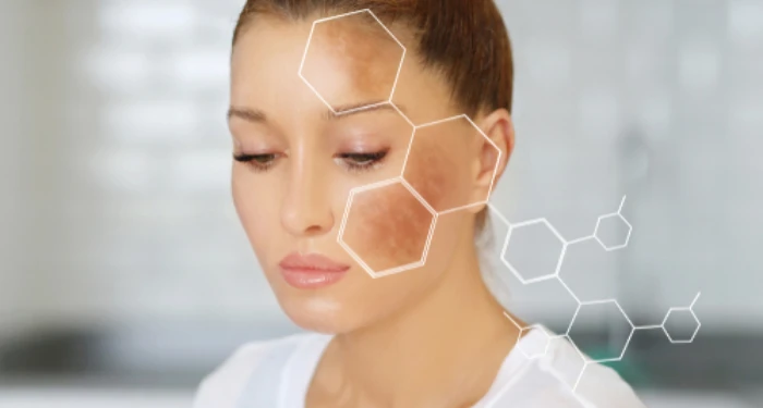 Melasma: Symptoms &amp; Treatment