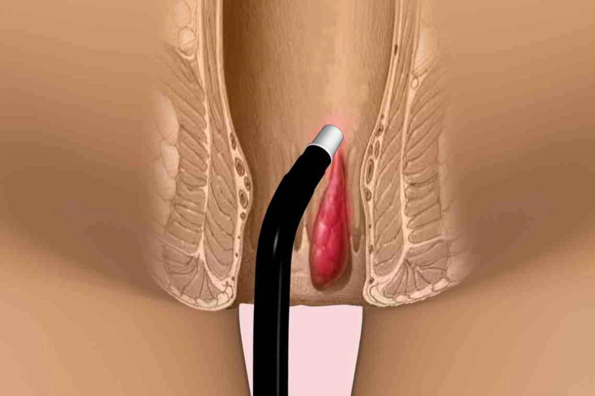 Piles Laser Surgery Cost In India