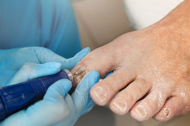 Five Common Types Of Foot Surgery