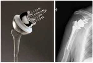 Global Reverse Shoulder Arthroplasty Market Report By Types, Applications, Players And Regions 2021
