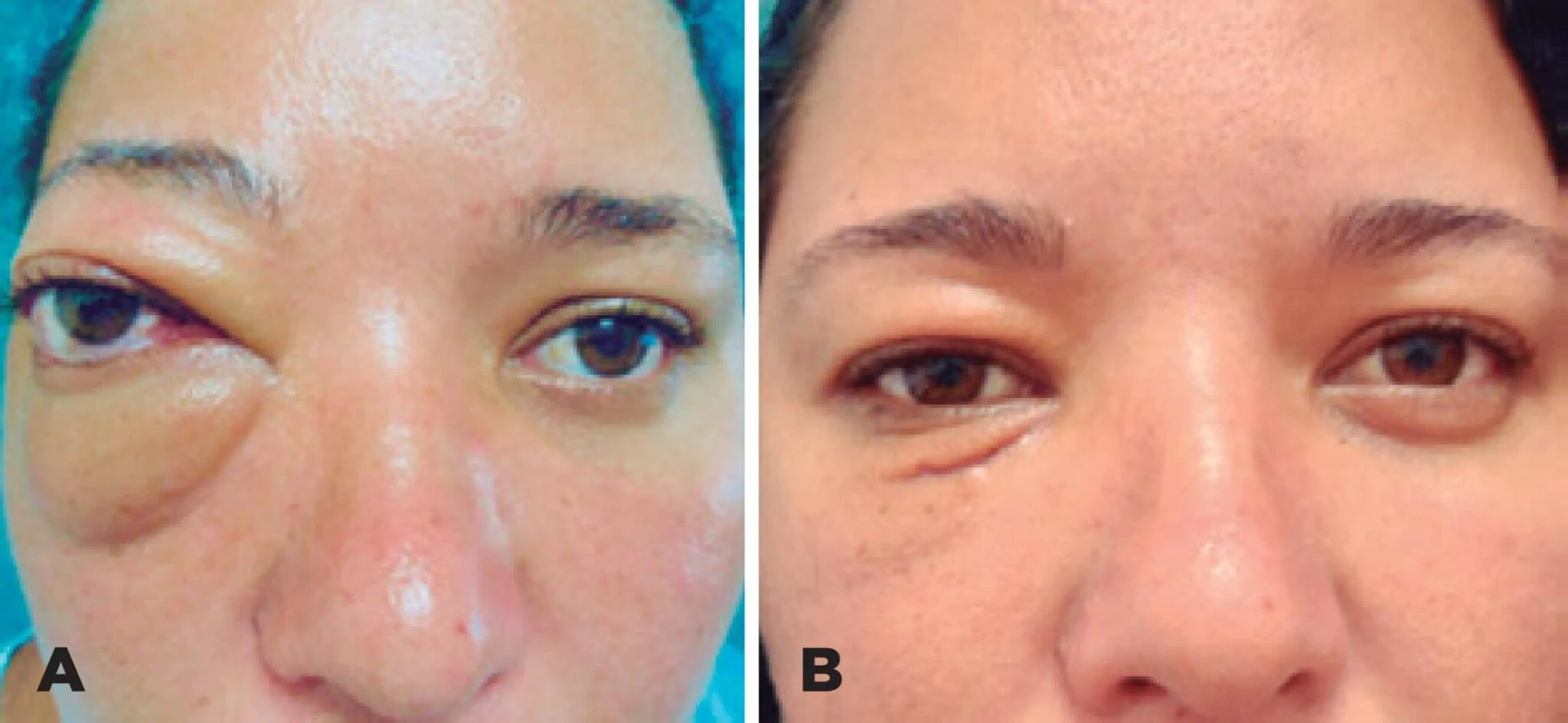 Undifferentiated Pleomorphic Sarcoma - Symptoms, Causes, and Treatment