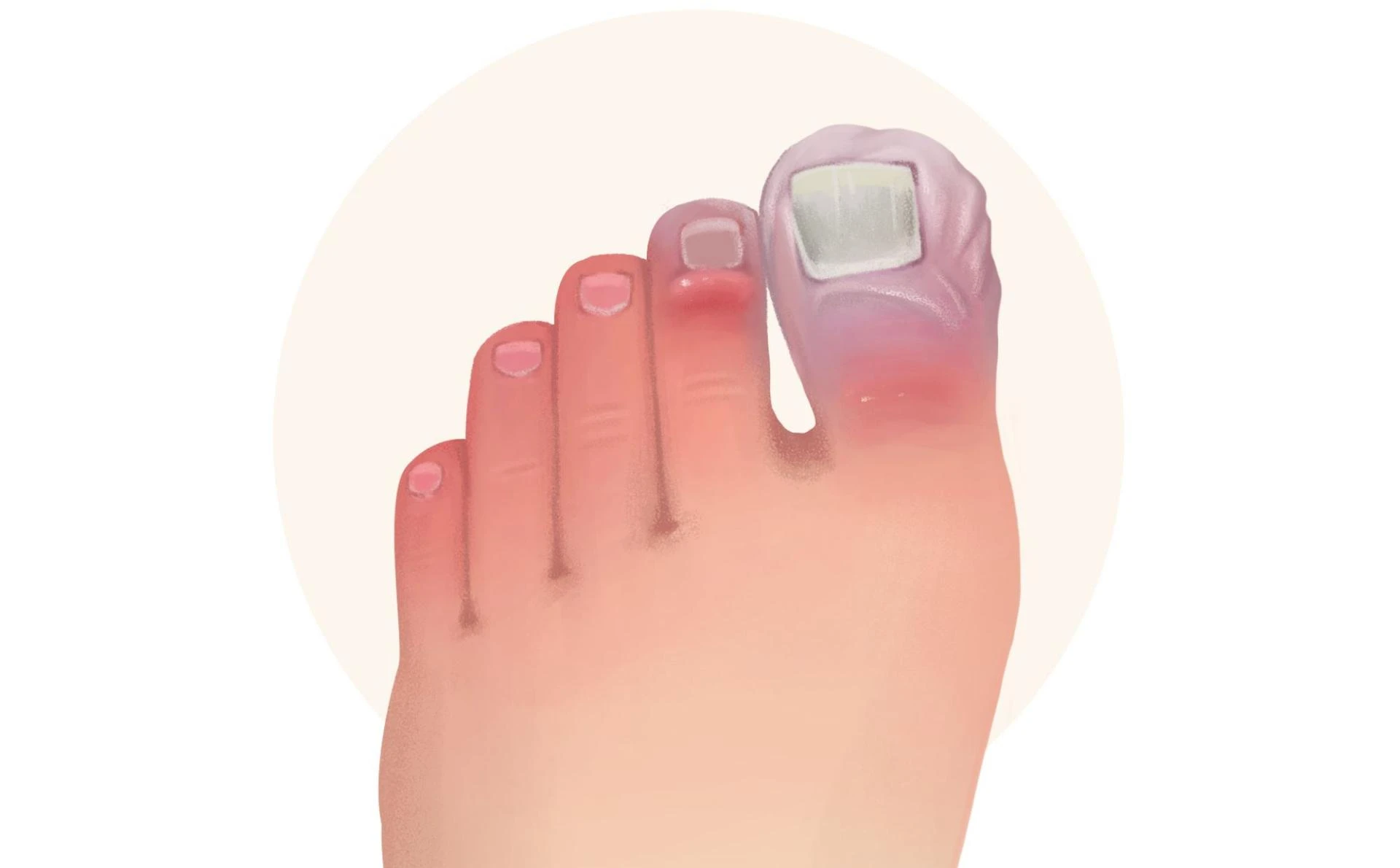 Chilblains: Cold Weather Woes