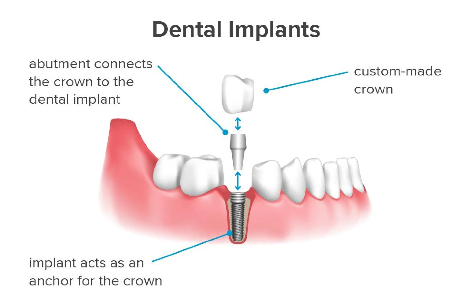 Dental Implant- The Most Recommended Option for a Patient