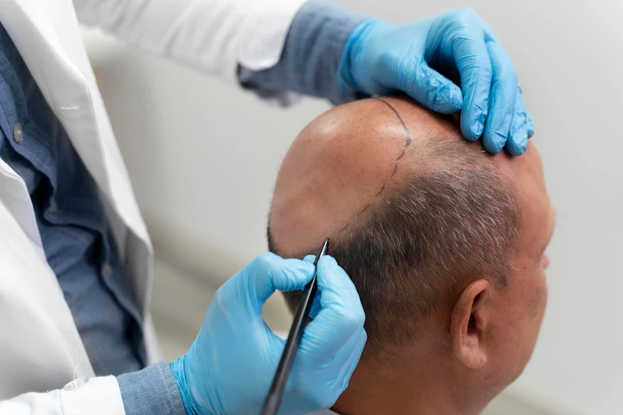 The Ultimate Guide to Hair Transplant Surgery