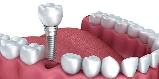 Are Dental Implants Right for You? A Comprehensive Overview