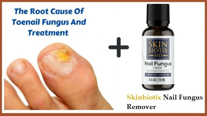 SkinBiotix Nail Fungus Remover - Safe Toenail Fungus Oil or Customer Results?