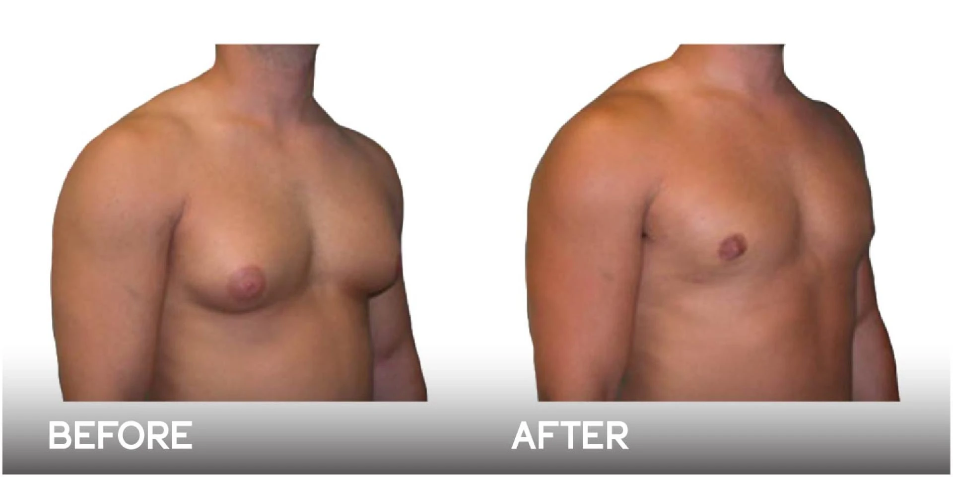 Do You Need Gynecomastia Surgery?