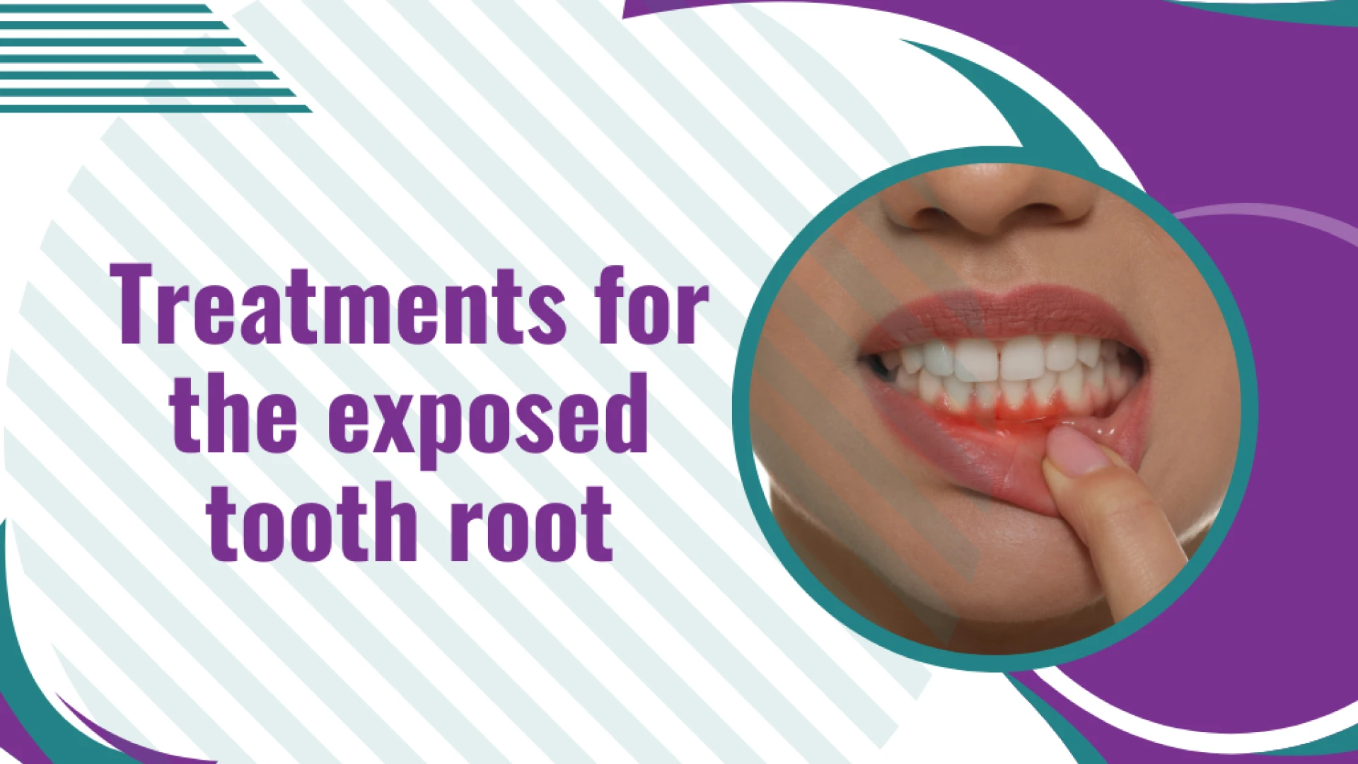 Treatments for the exposed tooth root