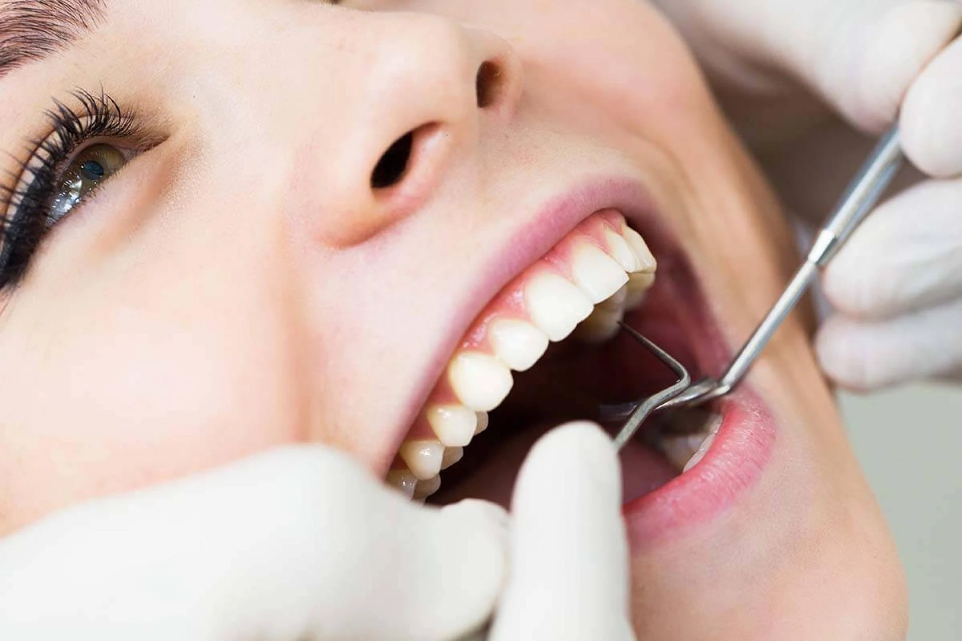 The Ultimate Guide to Finding Affordable Dental Fillings in Houston