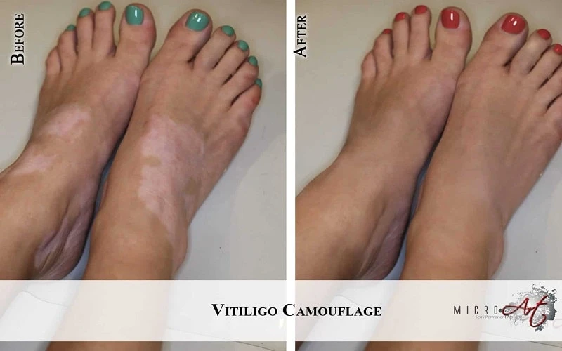 Vitiligo Treatment - MicroArt Semi Permanent Makeup