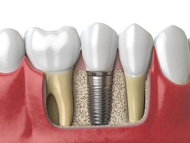 The Purpose of Dental Implants Explained