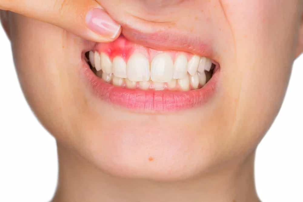 Gum Disease - Prevent Gum Disease at Home