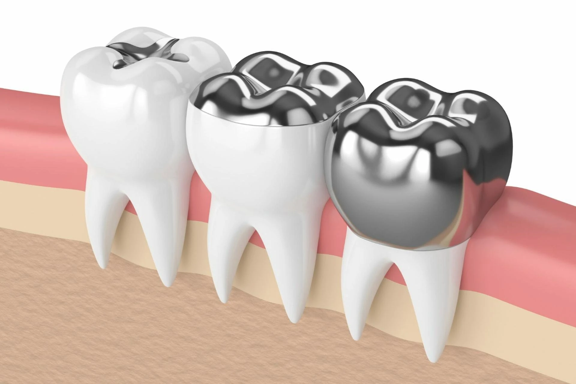 Huge Growth of Dental Filling Material Market  2021