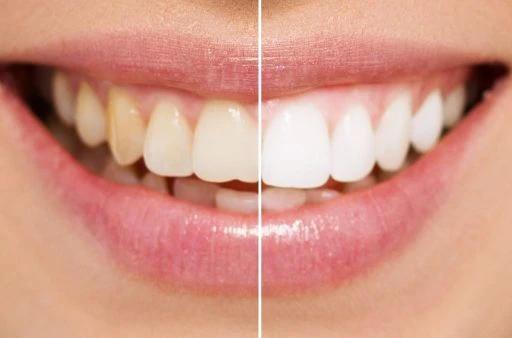 How long does sensitivity last after teeth whitening?