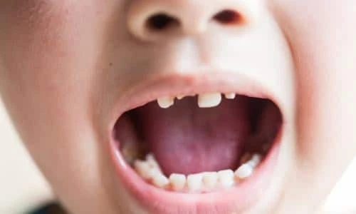 Do’s &amp; Don’ts of Tooth Extraction for Kids