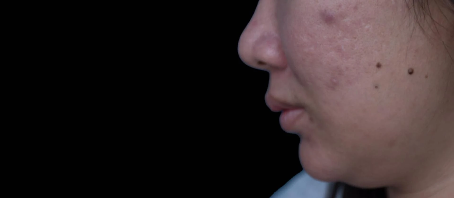 Why Do People Get Acne Scars?