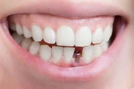 what is dental implants treatment