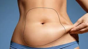 what is Laser Liposuction treatment