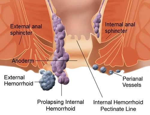 Treatment procedures for internal and external hemorrhoids are known as Hemorrhoid Treatment Devices