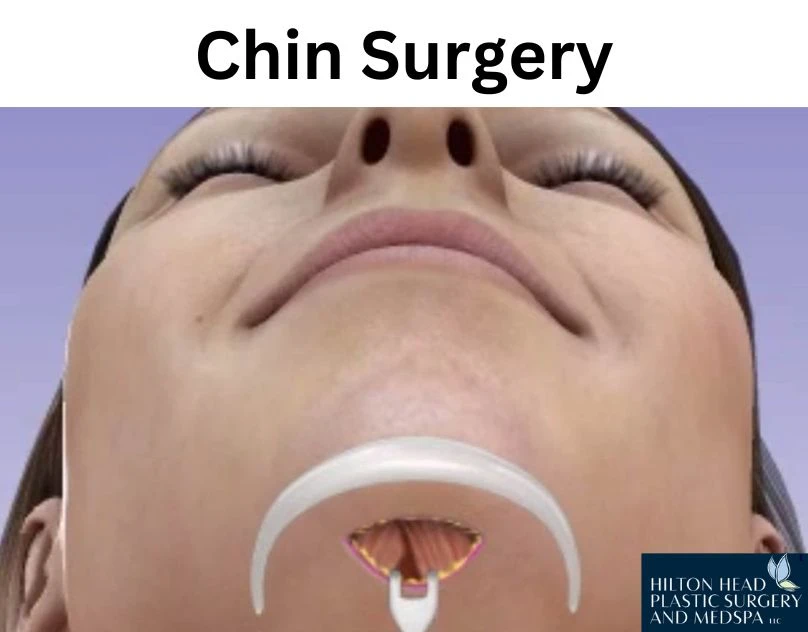 Boost Your Confidence with a Perfect Chin Surgery