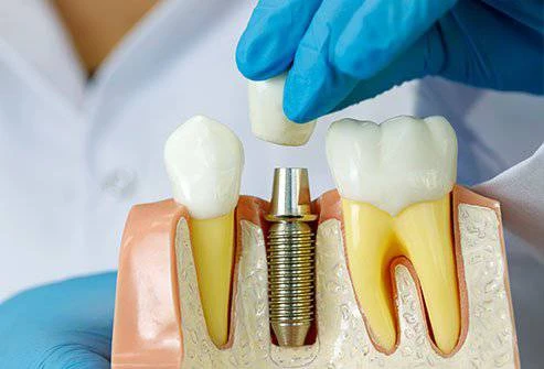 Best Dental Implants in Chinchwad - Eternal Smile