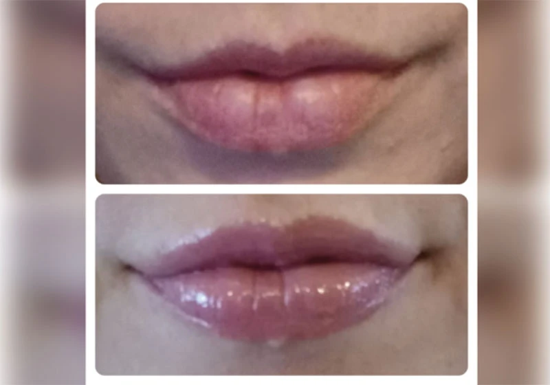 Everything You Need to Know About Lip Filler